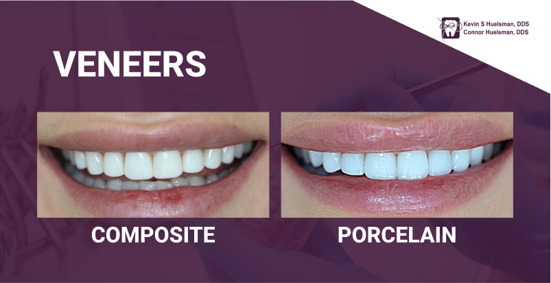 Porcelain Veneers