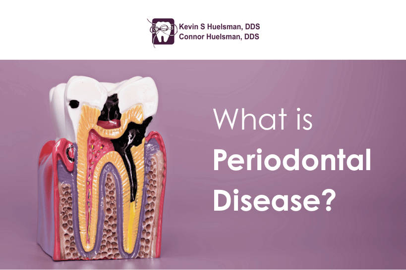 Tooth model showing periodontal disease and tartar buildup